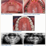 Dental Implant before & after pictures