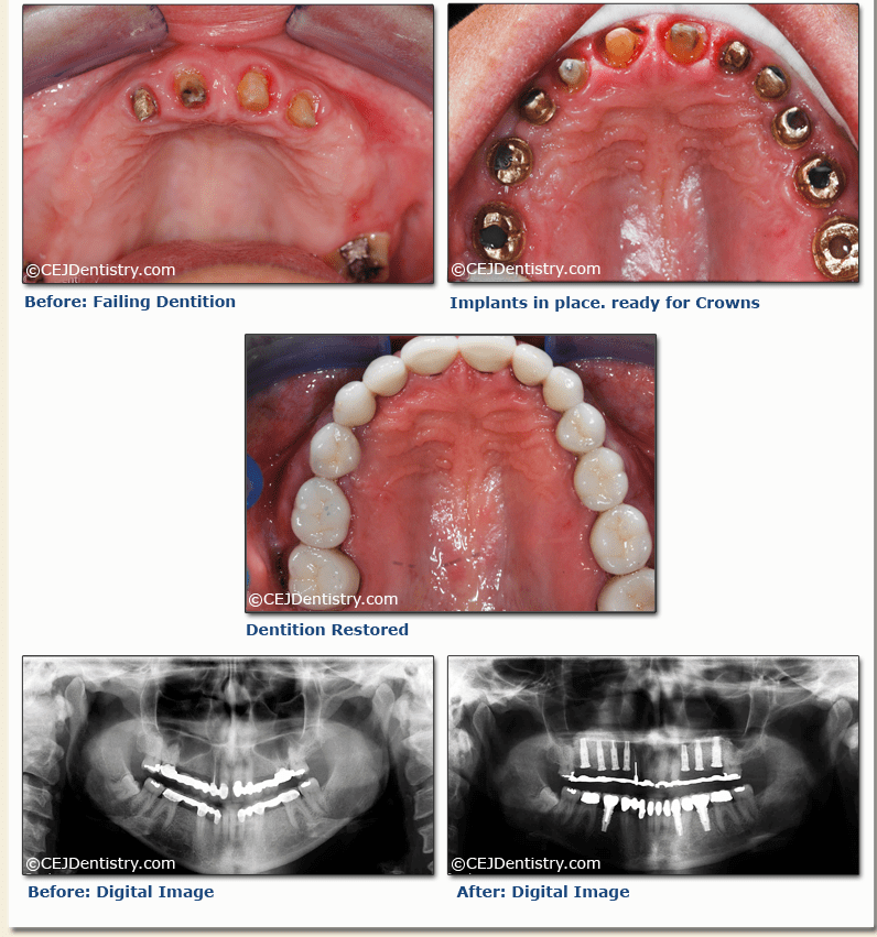 Dental Implant before & after pictures