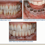 Dental Implant before & after pictures