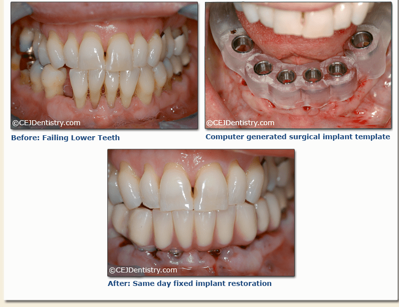 Dental Implant before & after pictures