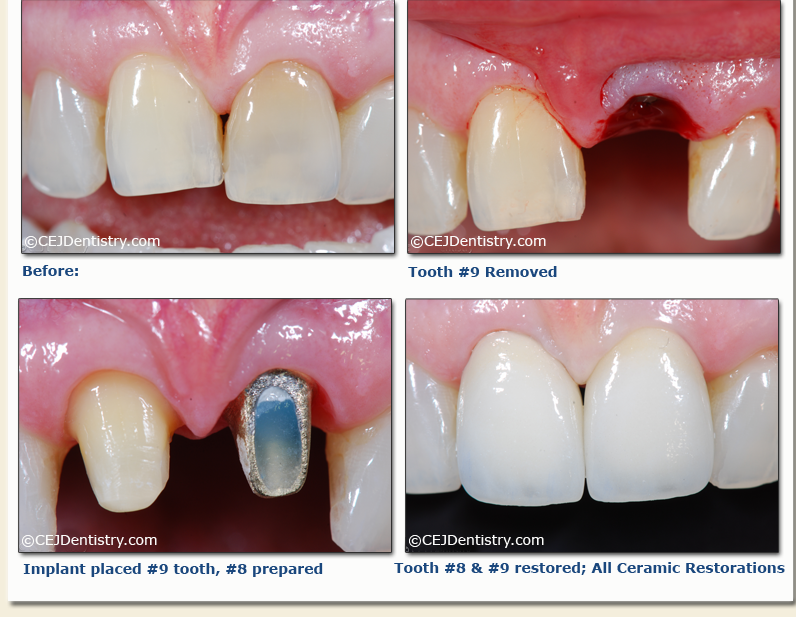 Dental Implant before & after pictures