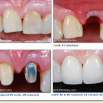 Dental Implant before & after pictures