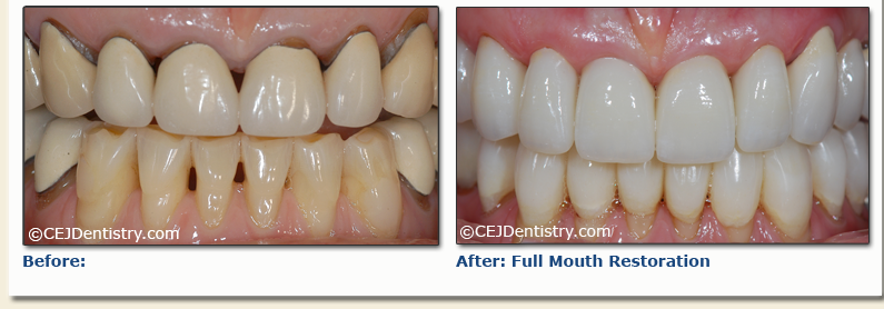 Full mouth restoration before & after