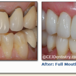 Full mouth restoration before & after