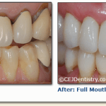 Full mouth restoration before & after