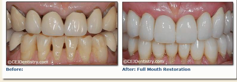 Full mouth restoration before & after
