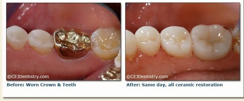 Ceramic Crowns before & after