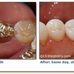 Ceramic Crowns before & after