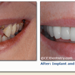 Implant & ceramic crowns before & after
