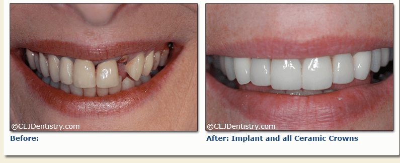 Implant & ceramic crowns before & after